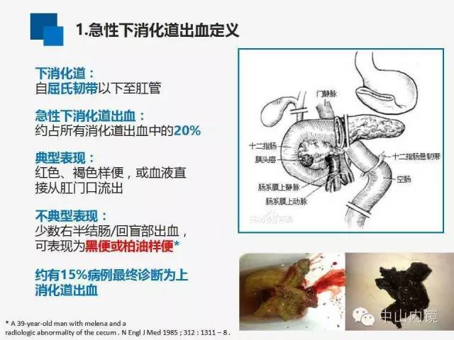 "急性下消化道出血诊治指南"学习笔记