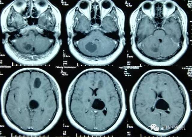 【罕见】病例讨论 华山脑胶质瘤mdt tumor board case review xv