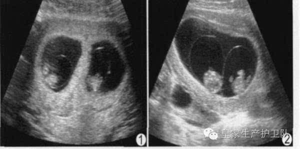 所以对医生来讲,相比单卵还是双卵,我们更关心的是绒毛