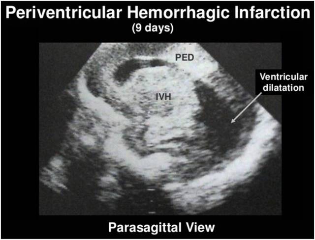 ivh-Ⅳ级:头颅超声图(旁矢状面):脑室内出血伴脑实质出血(第九天)