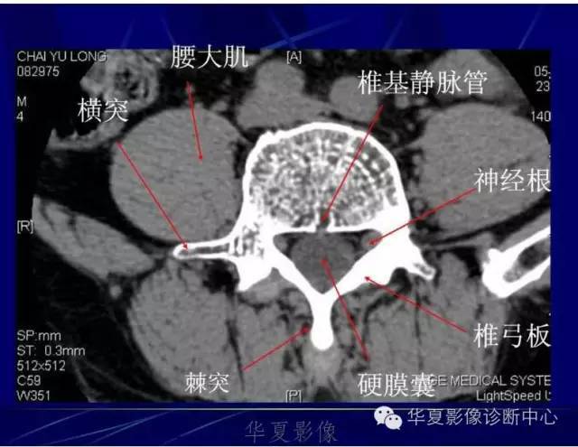 详细的腰椎解剖,椎间盘突出,膨出,看这里