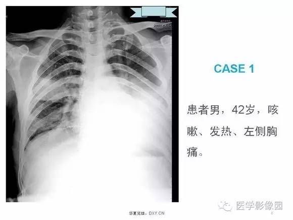 干货!一文鉴别肺炎,结核与肺部肿瘤