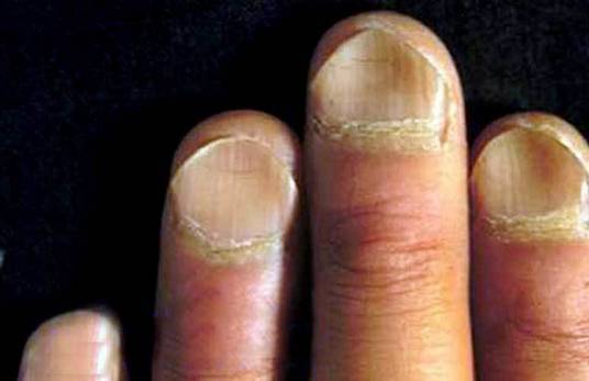 指甲中部凹陷,边缘翘起,这种指甲叫做匙状指,是缺铁性贫血的一个症状