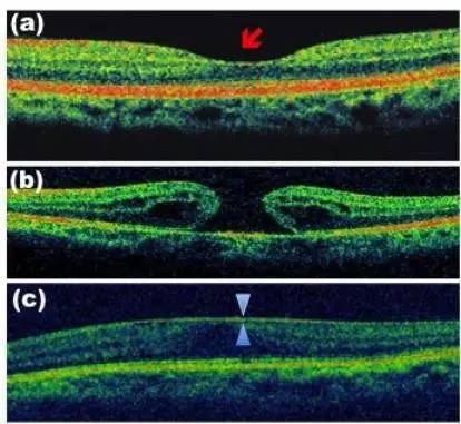 oct检查示(a)正常黄斑(红色箭头所指凹陷处);(b)黄斑裂孔;(c)黄斑前