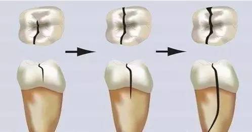 牙齿劈裂了怎么办