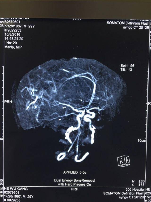 术前头部cta示大脑中动脉走形分支区域见增粗动脉血管影,局部呈结节状
