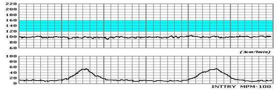 iii类胎心监护图形