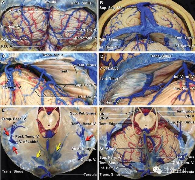 此处的静脉走行于小脑幕面和小脑幕之间,进入天幕窦,横窦或窦汇