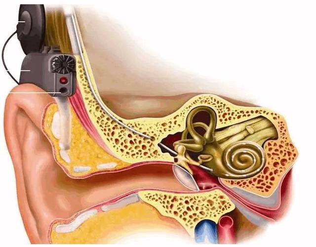 人工耳蜗——家长十项须知