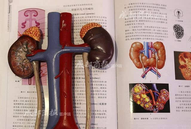 左边是正常人的肾,右边为马蹄肾.  ◎吃了两年胃药