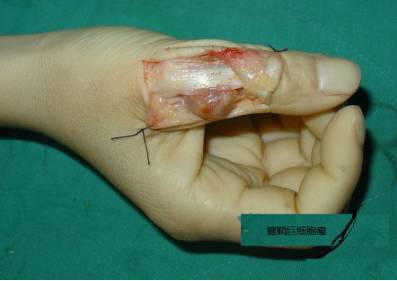 有时候和手指的腱鞘囊肿鉴别困难,腱鞘囊肿多发