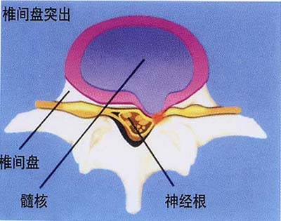 腰椎间盘突出是指腰椎间盘纤维环破裂,导致髓核突出,从而引起腰部疼痛