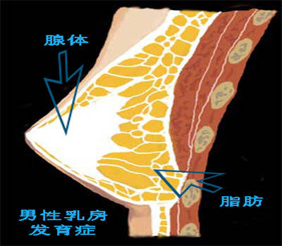 男性乳腺发育后,其腺体成份主要集中于乳头乳晕复合体的深面处;另外