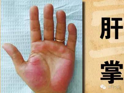 3 患有肝病的病人, 手掌颜色与常人的手掌颜色大不相同, 普通人的