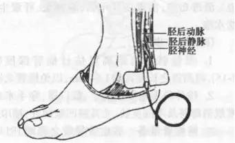 图 8. 足背动脉穿刺 胫后动脉穿刺 胫后动脉穿刺 1.