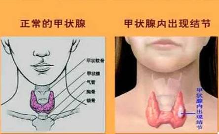 甲状腺结节癌变率高吗,到底要不要手术?术后只能吃"无碘盐"?