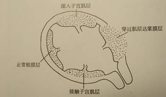 胎盘植入示意图