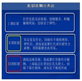 肛裂的临床分期并无绝对清晰的标准,多以症状,裂口情况及伴随的病理