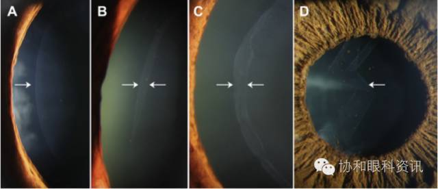 【文摘速递】真性囊膜剥脱综合征裂隙灯下的多样表现