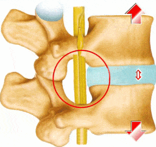 腰椎盘突出和骨质增生有什么区别