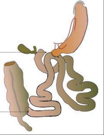 sips(stomach intestinal pylorus sparing)手术