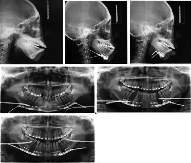 图3 治疗前头颅侧位片及曲面体层片,曲面体层片示:双侧颞下颌关节髁