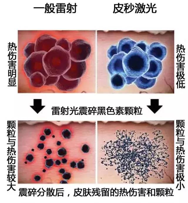 皮秒专业解疑篇——针对祛斑治疗,及注意事项