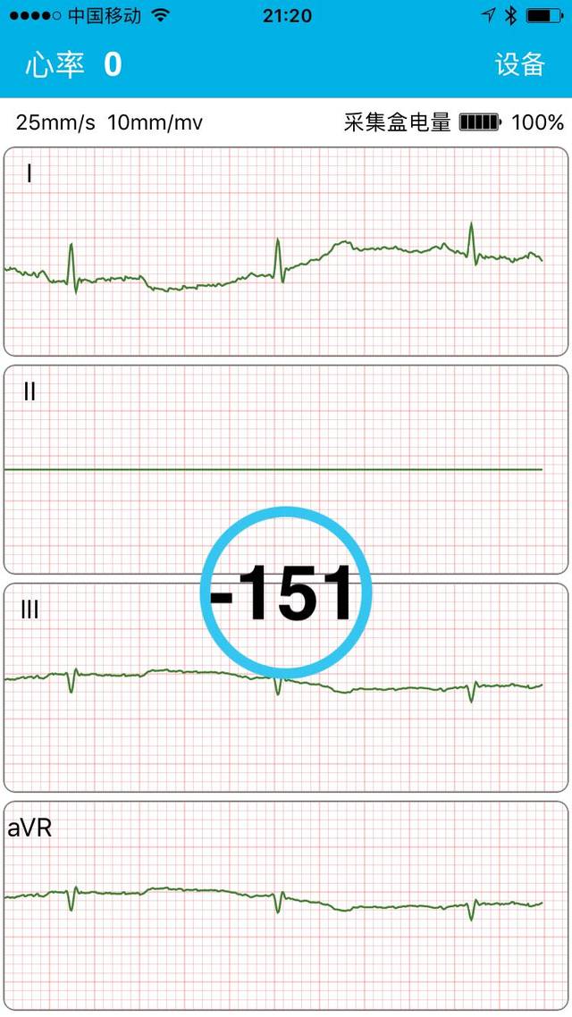 好朋友心电图机试用报告:和三甲医院检测基本一致