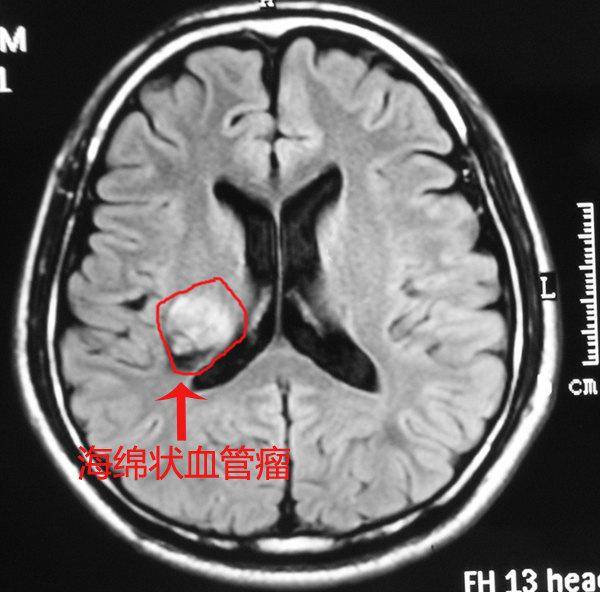 ct及mri:颅内多发海绵状血管瘤,右侧颞叶病变出血. 神经导航下右侧颞