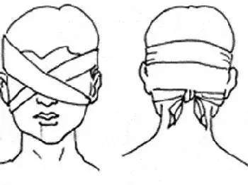 ②双眼包扎法:将三角巾折成四指宽的带状巾,将中央部盖在一侧伤眼上