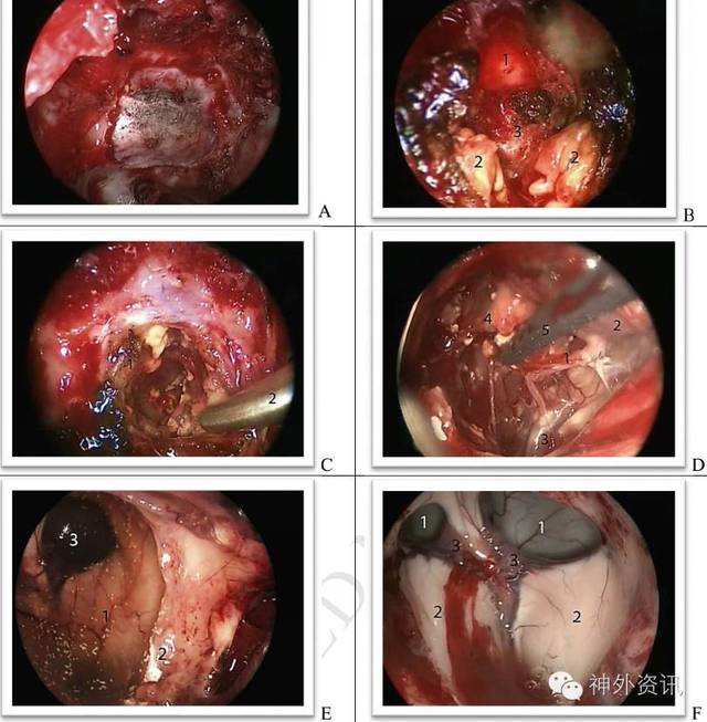 手术在磨除上述的前颅底骨质后,可见到肿瘤.