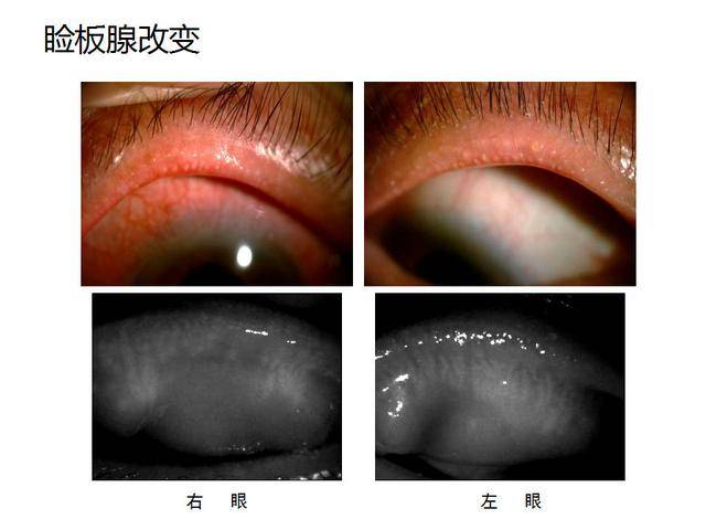 眼睑缘炎的原因及治疗