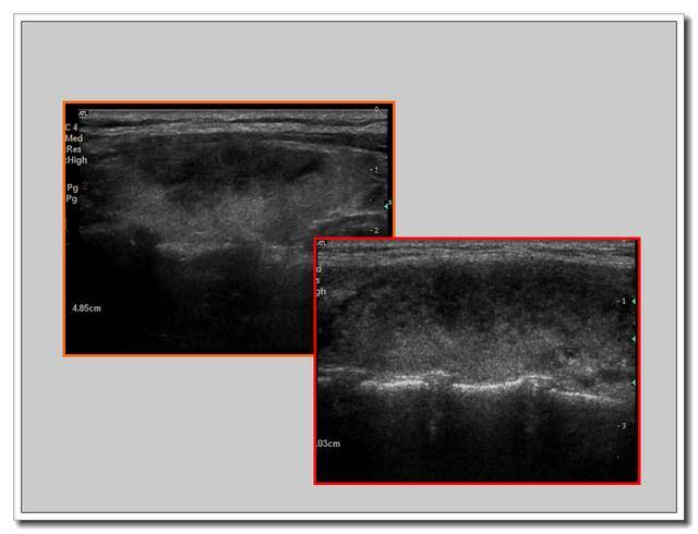 甲状腺超声报告怎么看?