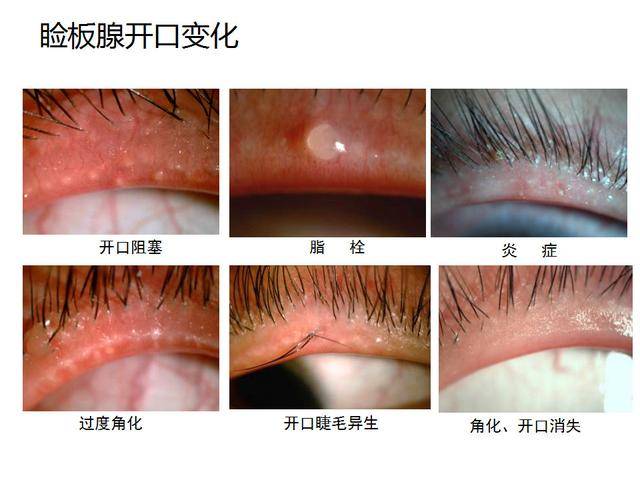 眼睑缘炎的原因及治疗