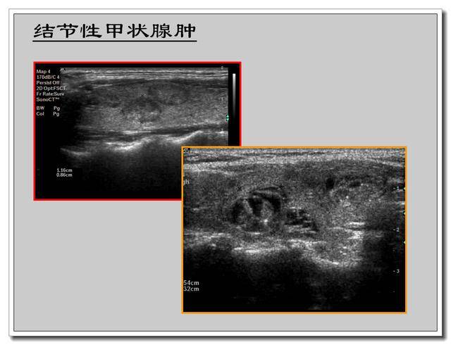 甲状腺超声报告怎么看?