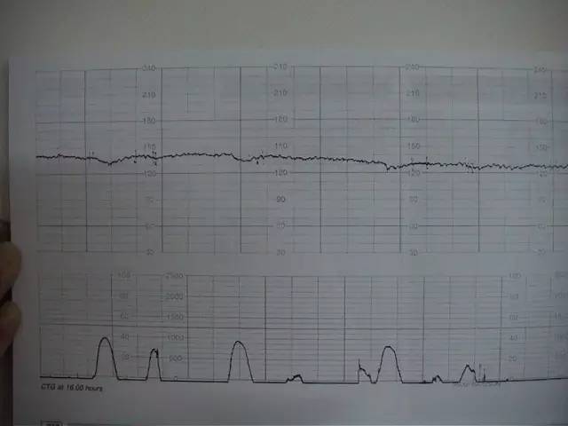 孕妈妈,你和胎心监测之间有个误会!