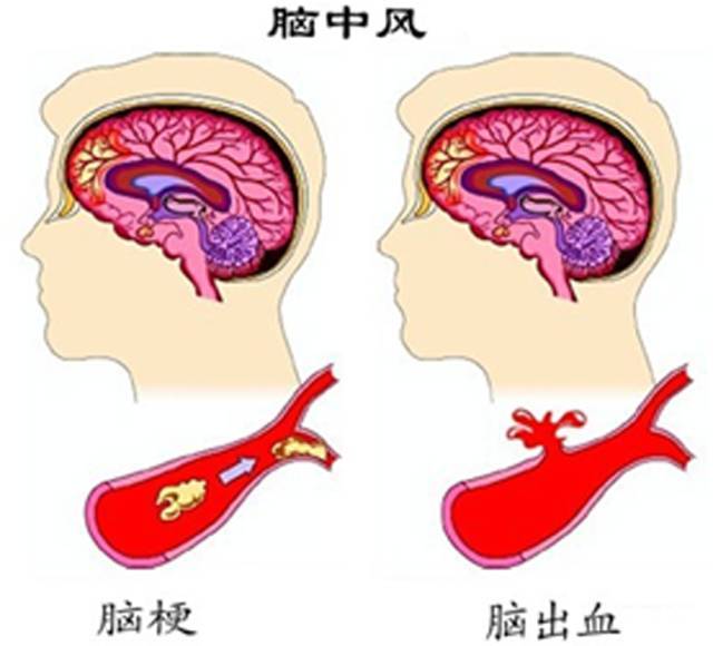 脑溢血:脑血管不笫サ员浯嗳菀灼屏,当血压高时引发破裂出血.