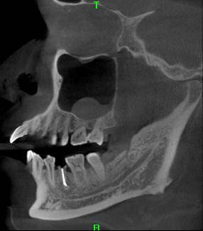 仔细观察下颌骨骨小梁,颞颌关节,下颌神经管 同时可以根据需要选择