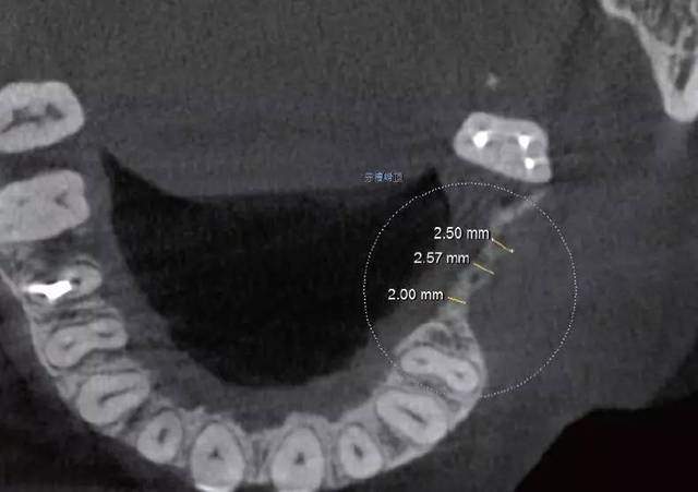 cbct显示rbh=8.22 mm(图16),牙槽嵴顶骨宽度2~3 mm(图17).