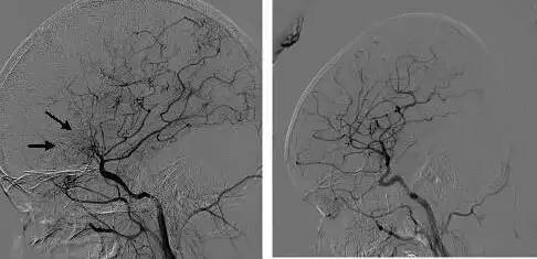 烟雾病脑血管造影 正常脑血管造影