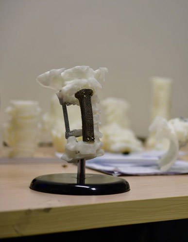 世界首例大跨度颈椎切除术 北医三院3D打印再