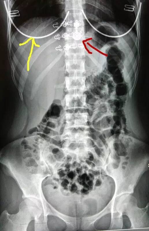 图3 再看看图三,这是一个腹部平片,用老百姓的话就是拍肚子的x光片子