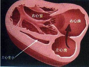 正常人的心脏包括左右两侧心室,心房,只长一侧心室,心房,而且合并有主