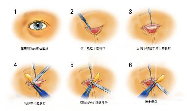 希典·时尚志-眼部(双眼皮)整形法普及知识!