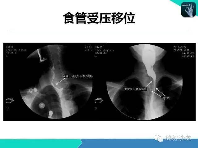 值得收藏的全套消化道钡餐图(食管,胃,小肠,结肠,直肠