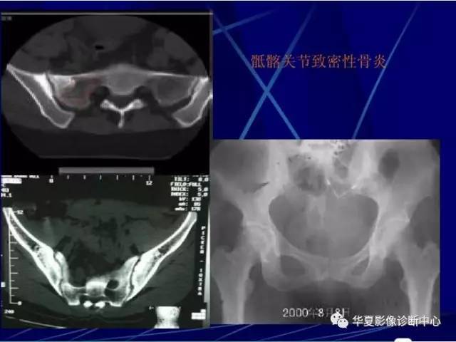 骶髂关节病变的ct区分