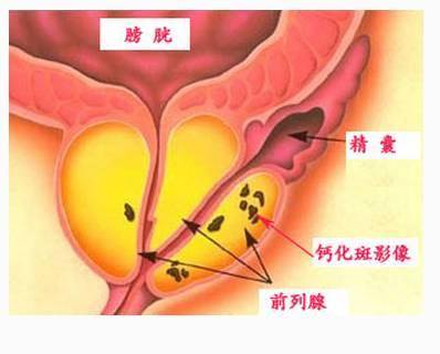 前列腺增生、钙化,应吃这些健康食物!