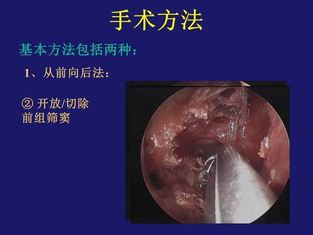 鼻内镜真菌球型上颌窦炎的手术治疗