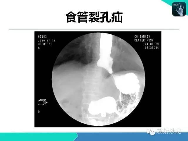 值得收藏的全套消化道钡餐图(食管,胃,小肠,结肠,直肠