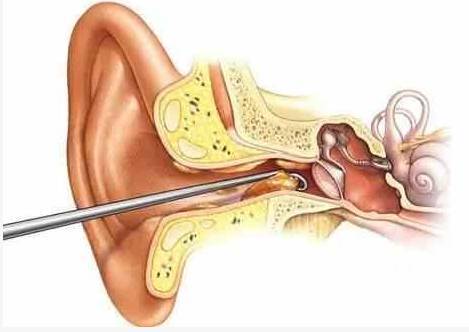 耳屎越掏越多? 告诉你耳屎到底该不该掏